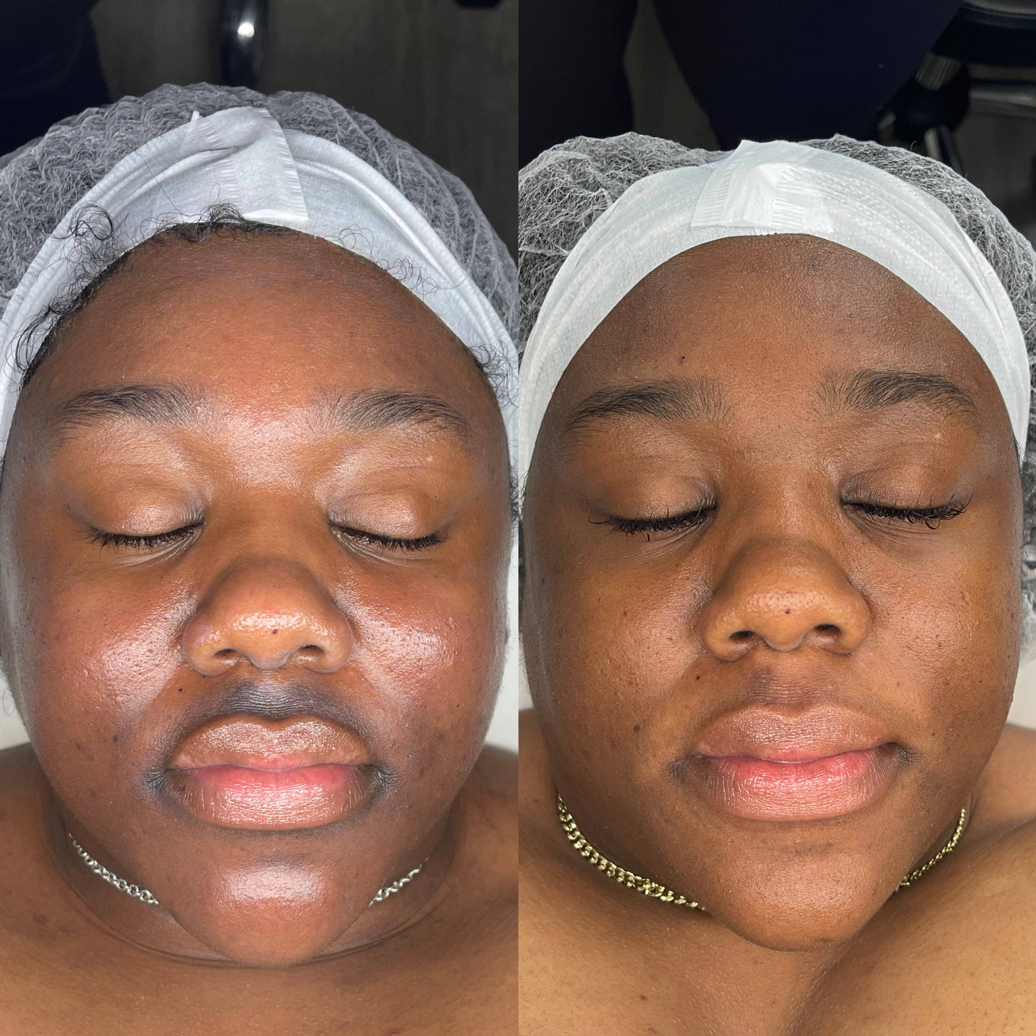 Before and after facial brightening