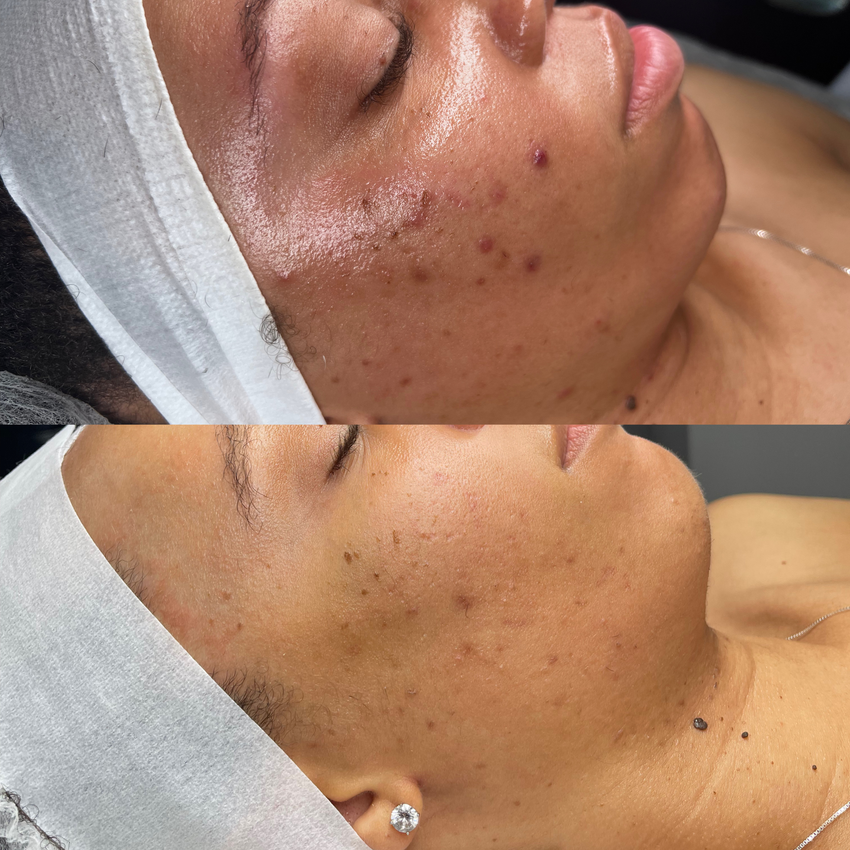 Before and after texture treatment