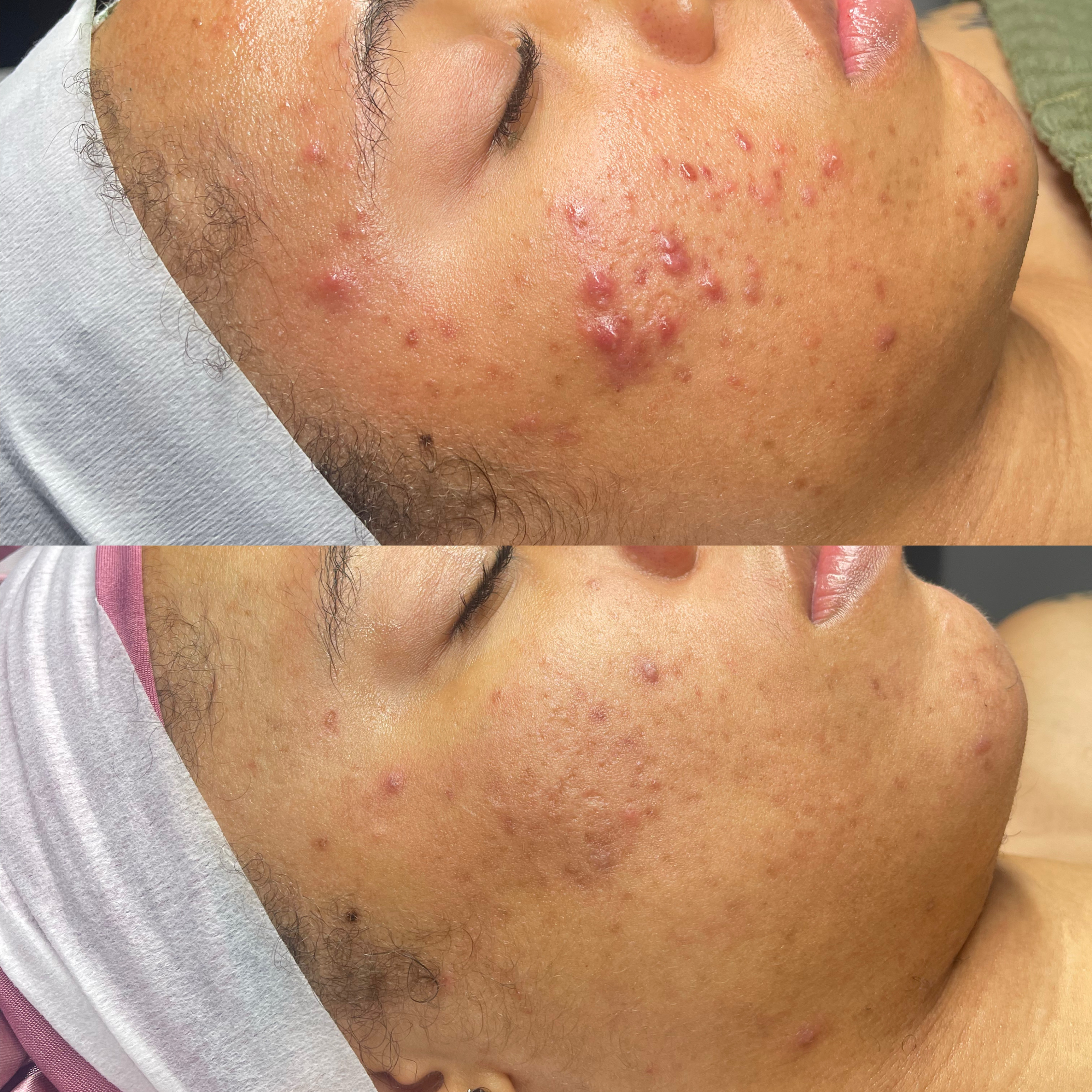 Before and after acne treatment