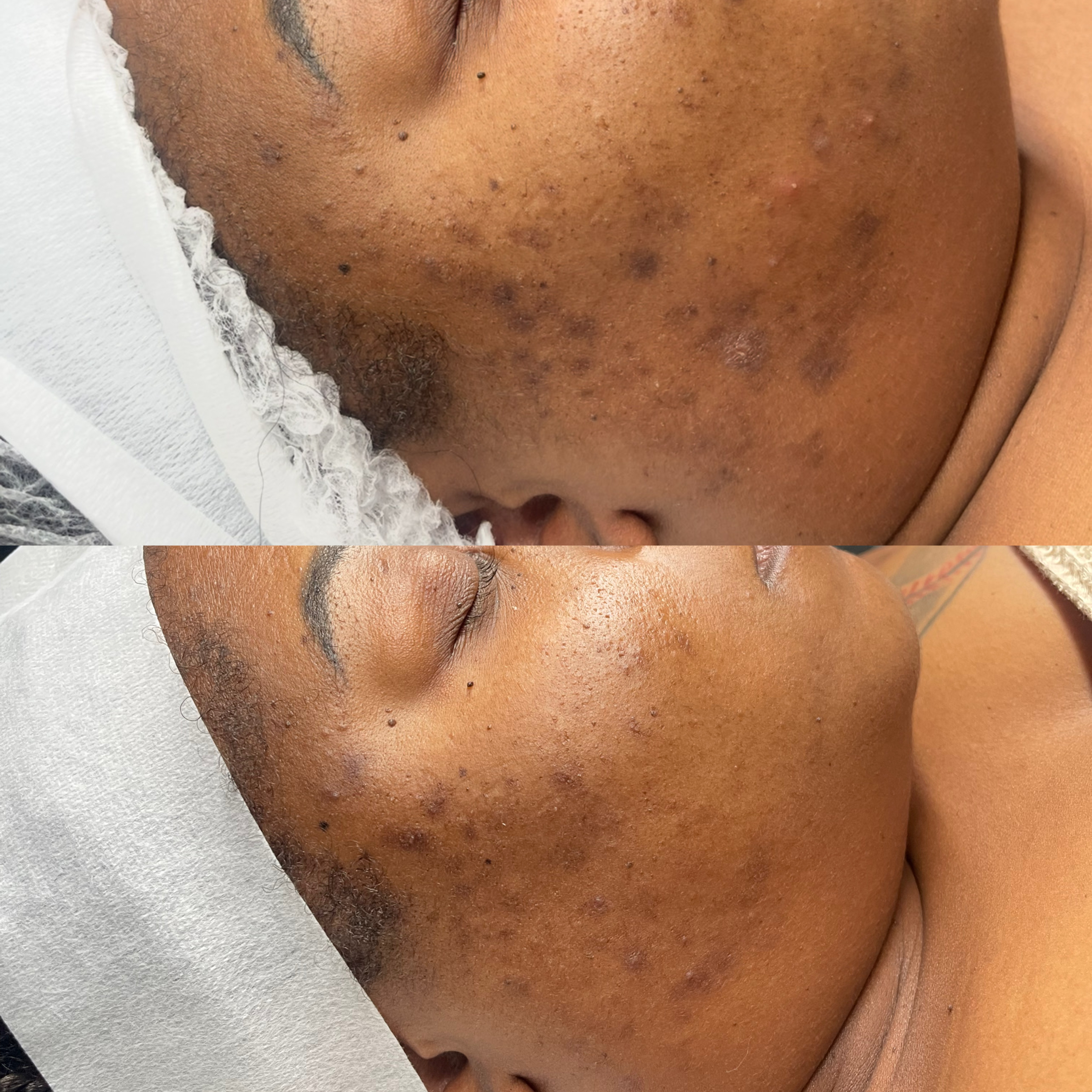 Before and after dark spot treatment