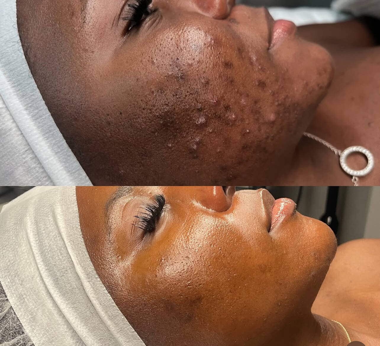 Before and after acne and texture treatment